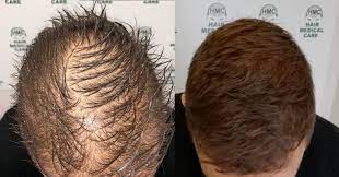 Di dover smettere le cure volta eseguita la micro pigmentazione. Hai Eseguito Un Trapianto Di Capelli Da Un Anno Non Sapevi Che Medita Medical