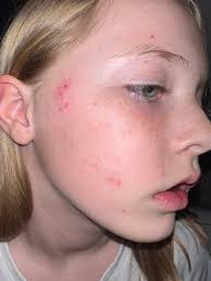 Treatment for Molluscum contagiosum with Skin Virus Drops