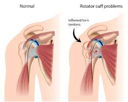 How To Prevent Rotator Cuff Injuries - Advanced Orthopedics Institute