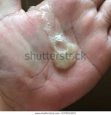 Image result for phlegmon of hand)