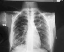 The samples are tested for tb bacteria. Chest X Ray Of The Same 17 Year Old Female With Active Tb Due To Download Scientific Diagram