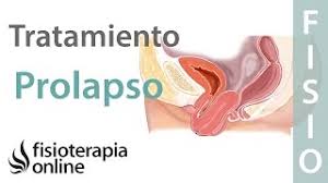 Que Es El Prolapso En El Suelo Pelvico Tratamiento Adecuado En Fisioterapia Youtube
