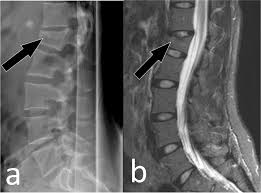 Image result for Vertebral Compression Fracture