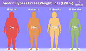 how much weight will i lose with gastric bypass surgery