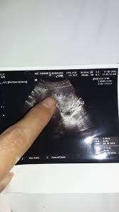 Penebalan dinding rahim dapat memicu terjadinya kanker endometrium, penyebabnya adalah ketidakseimbangan hormon, simak penjelasan lengkapnya. Penebalan Dinding Rahim Awal Kehamilan Salam Sehat