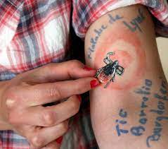 La maladie de lyme est le résultat de la transmission sanguine d'une bactérie, le borrelia burgdorferi, par le biais du parasite de type ixodida. Maladie De Lyme Errance Dans Les Salles D Attente