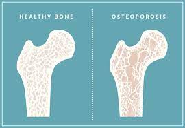 Identifying The Early Signs Of Osteoporosis Sc Internal Medicine Associates Rehabilitation Llc