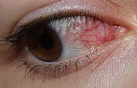 Hilfe Rotes Auge Bild Augen Rot