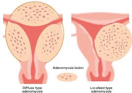 For instance, endometriosis is a condition where the lining of the uterus grows outside of the uterus. Obstetrics And Gynecology Disease Leiomyoma Endometriosis Adenomyosis Of The Uterus Treatment Of Disorder Tokushukai Group
