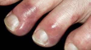 © 2021 infermedica ce marking terms of service privacy policy {{ ::panel.title }} {{ ::link.title }}. Coronovirus Le Nouveau Symptomes Des Orteils Rouges