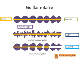 Gbs komt zowel bij mannen als vrouwen voor en op alle leeftijden. Kinderneurologie Eu