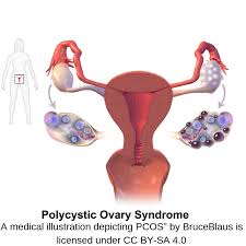 This subreddit is intended to serve as both an educational resource, as well as a safe place to share and listen. The Facts About Pcos Military Families Learning Network