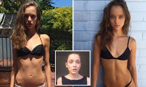 Model who battled anorexia says she once weighed just 34 kilograms | Daily  Mail Online