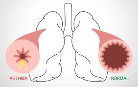 40 ml pestwurz, je 20 ml fenchel, huflattich, meersträubel, thymian. Asthma Bronchiale Ursachen Symptome Und Therapie