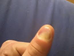 Ist Es Moglich So Viel Eiter Raus Zu Bekommen Finger