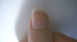 Maybe you would like to learn more about one of these? Las Manchas Blancas De Las Unas No Significan Falta De Calcio Ecodiario Es