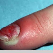 Image result for paronychium