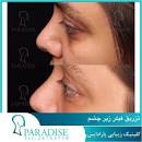 نتیجه تصویری برای تزریق فیلر در ناحیه زیر چشم