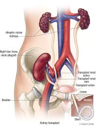 Imaging Of Renal Transplant Complications Throughout The Life Of The Allograft Comprehensive Multimodality Review Radiographics