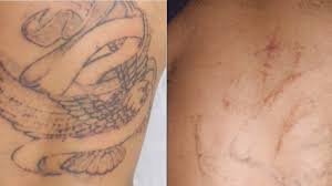 You may also risk lack of complete pigment removal, and there is a slight chance. Tattoo Removal How To Costs Before And After Pictures More