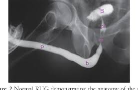 Image result for Retrograde Urethrogram