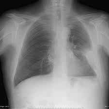 Pleural effusion is an accumulation of fluid in the pleural cavity between the lining of the lungs and the thoracic cavity (i.e., the visceral and parietal pleurae). Chronic Loculated Thoracic Empyema With Fade And Nonspecific Infectious Symptoms In An Elderly Patient With Diabetes Mellitus Eurorad