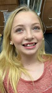 For all the millions of fans waiting, Lorelei finally got her braces on.  See her video to the left to follow her journey. #braces #smile #kids  #bully #sweet #love #fun #transformation #dentist #