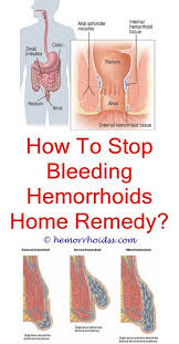 How Do Hemorrhoid Go Away What Goes Into A Sitz Bath For Hemorrhoids Do Stool Softeners Help Hemorrhoi Bleeding Hemorrhoids Hemorrhoids Hemorrhoids Treatment