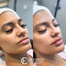 AUMENTO Y PERFILAMIENTO DE LABIOS CON RELLENO DE MENTÓN Y DE SURCOS  NASOGENIANOS👄🤫✨ El ácido hialurónico nos permite corregir y mejorar  diferentes zonas de nuestro rostros de una manera poco invasiva, natural