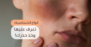 Ever wondered what nka means? Ø£Ù†ÙˆØ§Ø¹ Ø§Ù„Ø­Ø³Ø§Ø³ÙŠØ© ØªØ¹Ø±Ù Ø¹Ù„ÙŠÙ‡Ø§ ÙˆØ®Ø° Ø­Ø°Ø±Ùƒ ÙˆÙŠØ¨ Ø·Ø¨