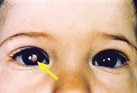 Lung cancer is characterized by the uncontrolled expansion of abnormal cells in the lungs. Visual Guide To Eye Cancers