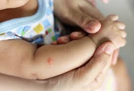 Make sure you use a minty flavor, and apply the menthol flavored toothpaste to the mosquito bite. Mosquito Bites In Babies Reasons Signs Home Remedies