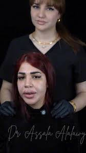 Harmony face technique ❤️‍🔥🥰 اذابة فلر الوجه القديم المحقون بطريقة خاطئة  وحقن الوجه بطريقة الشد والسحب 🥰❤️‍🔥 الدكتورة أصالة العلوي