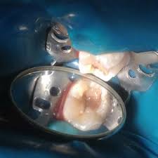 Clinical view of application of 2 mm of white MTA mark Angelus®