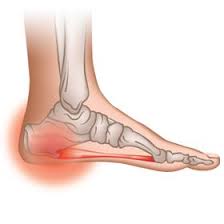 The Rest Of The Truth About Heel Spurs Home Remedies Natural Home Remedies Natural Treatments