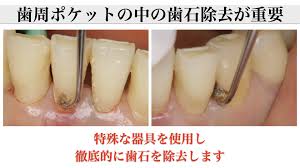 TASUKU DENTAL OFFICE｜インプラント