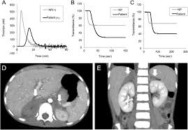 The lupus anticoagulant tests are blood clotting tests. Lupus Anticoagulant Hypoprothrombinemia Syndrome Associated With Bilateral Adrenal Haemorrhage In A Child Early Diagnosis And Intervention Thrombosis Journal Full Text