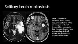 Brain Tumours Imaging Nuclear Medicine Brain Tumor Brain