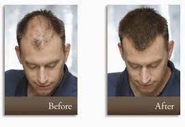 Infinity Hair Fibers Best Hair Concealer For Hairline Hair Loss Concealers Cool Hairstyles Hair Loss