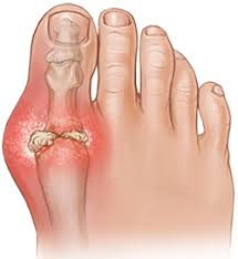 Image result for gout symptoms toe
