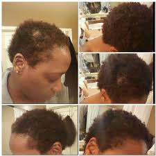 Alopecia Hairloss Prettea Www Madam Myflowindustry Com Healthy Hair Natural Hair Styles Alopecia