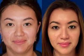 The only real way to slim down your cheek fat in a week or less is to flush out the bloating and water weight. A Slimmer Face With Buccal Fat Removal Thomas Taylor M D