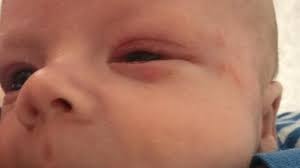 Herpes simplex virus (hsv) is a virus that usually causes skin infections. Barnsley Mum Neonatal Herpes Nearly Took My Baby Bbc News