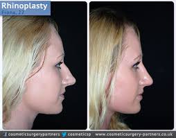 Nose Surgery Patient Case Study Rhinoplasty Cosmetic Surgery