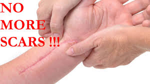 Your kids have lice and you don't know how to get rid of these bad things.watch this video. How To Get Rid Of Scars Tissue How To Remove Scars Natural Home Remedies Youtube