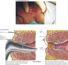 Image result for Perirectal Abscess