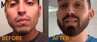5 things i wish i knew before i started minoxidil. How To Use Minoxidil For Your Beard Magnum Workshop