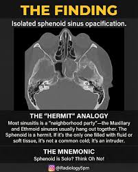 Image result for Sinusitis Prediction Rule