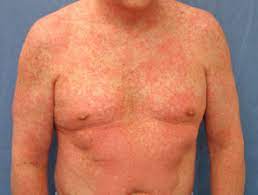 Morbilliform Drug Reaction Dermnet Nz