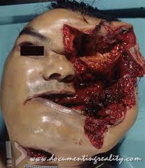 Learn more about gunshot injuries. 50 50 Delicious Pepperoni Pizza Sfw Gunshot Wound To An Eye Nsfl Fiftyfifty